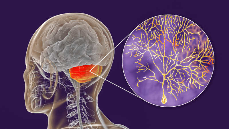 ataxia cerebelar